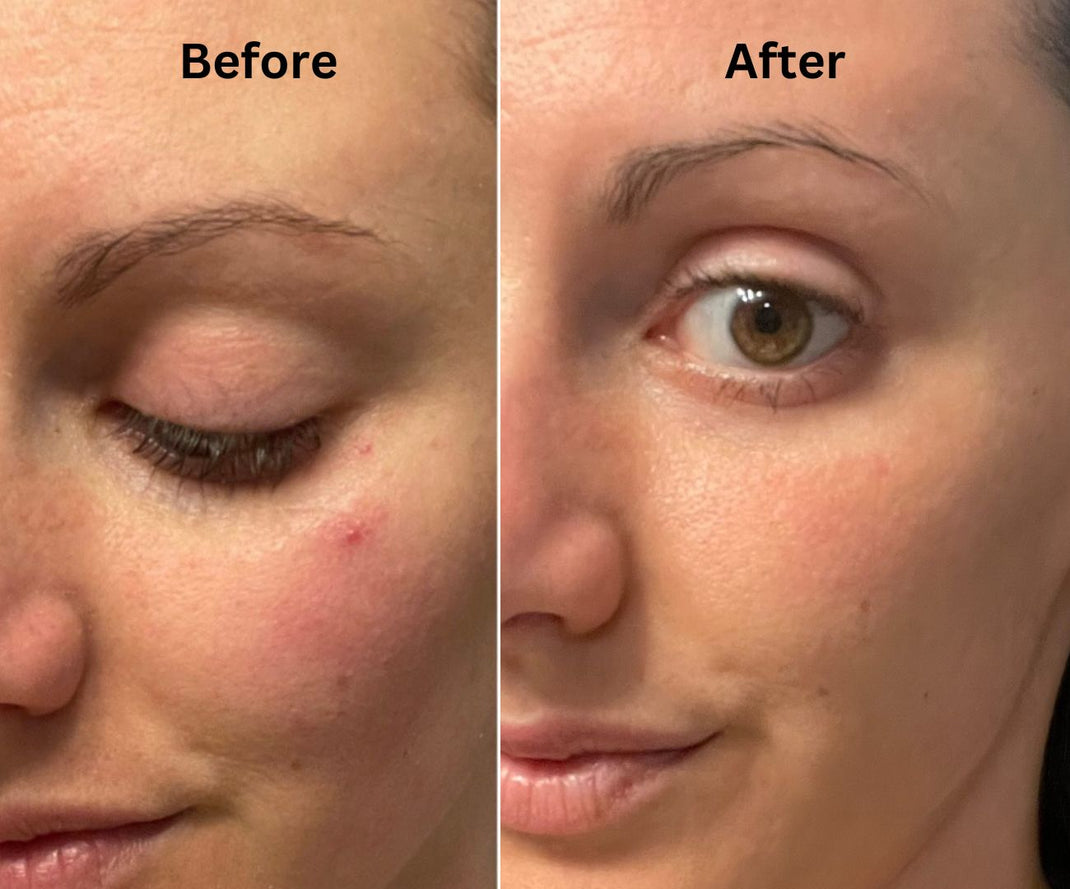 Simply Eden Tallow Skin Transformations Real Before After Results simply-eden-tallow-skin-transformations-real-before-after-results