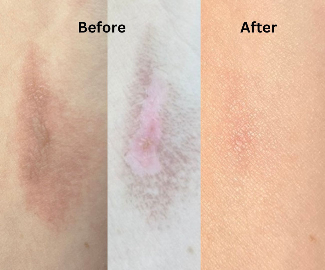 simply-eden-tallow-skin-transformations-real-before-after-results